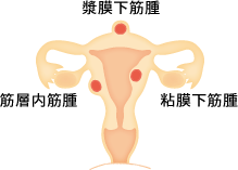 子宮筋腫のタイプ 筋腫全体の70％を占めるのが筋層内筋腫