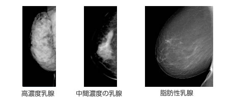 乳腺症 日立保険サービス